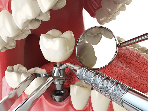 Best Emergency Dentist for Lost Fillings or Crowns in Boyceville, WI